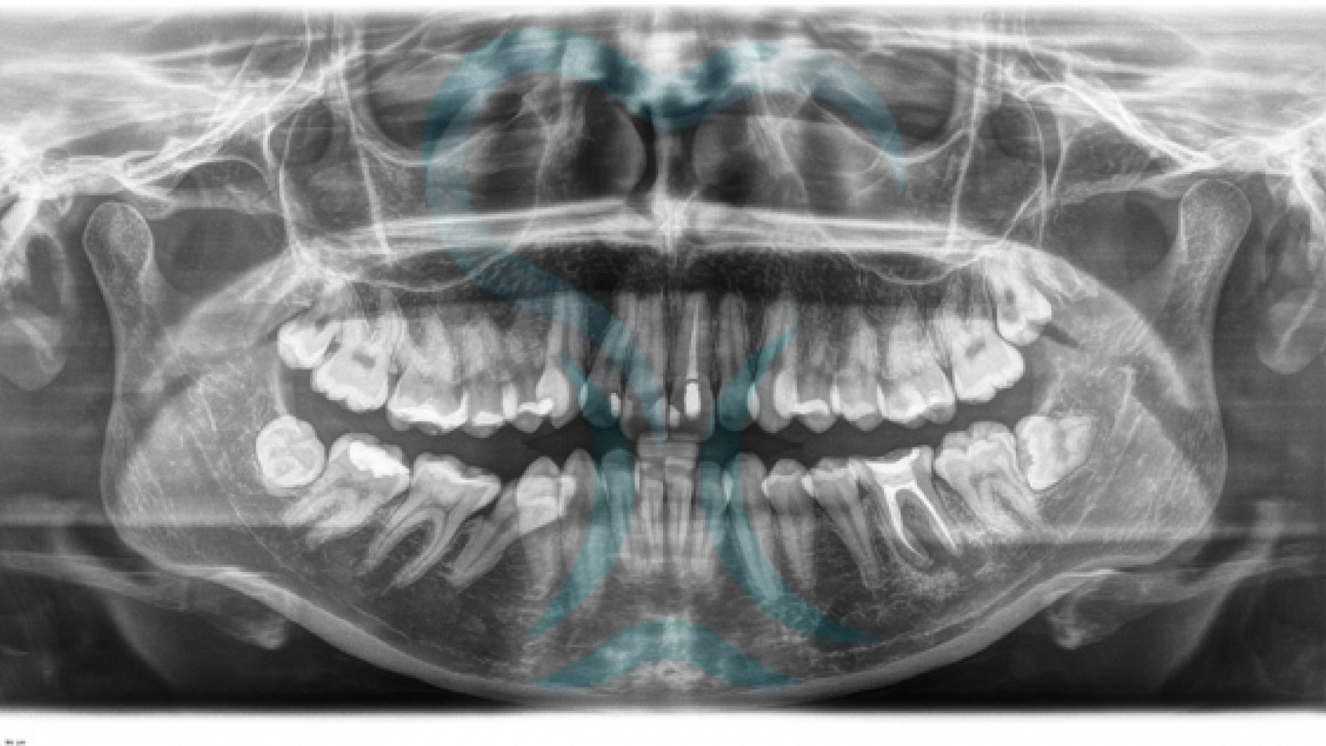 Ortopantomografia | Studio dentistico Dott. N. Anton