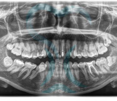 Ortopantomografia | Studio dentistico Dott. N. Anton